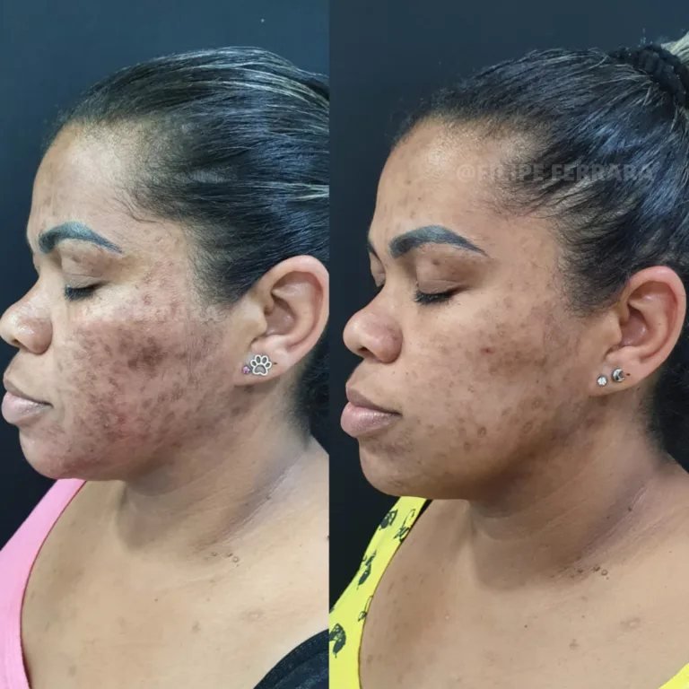 Antes e depois de caso de melasma