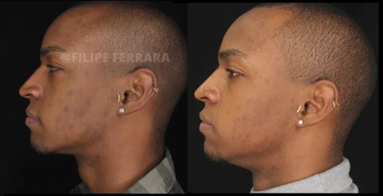 Antes e depois de caso de melasma