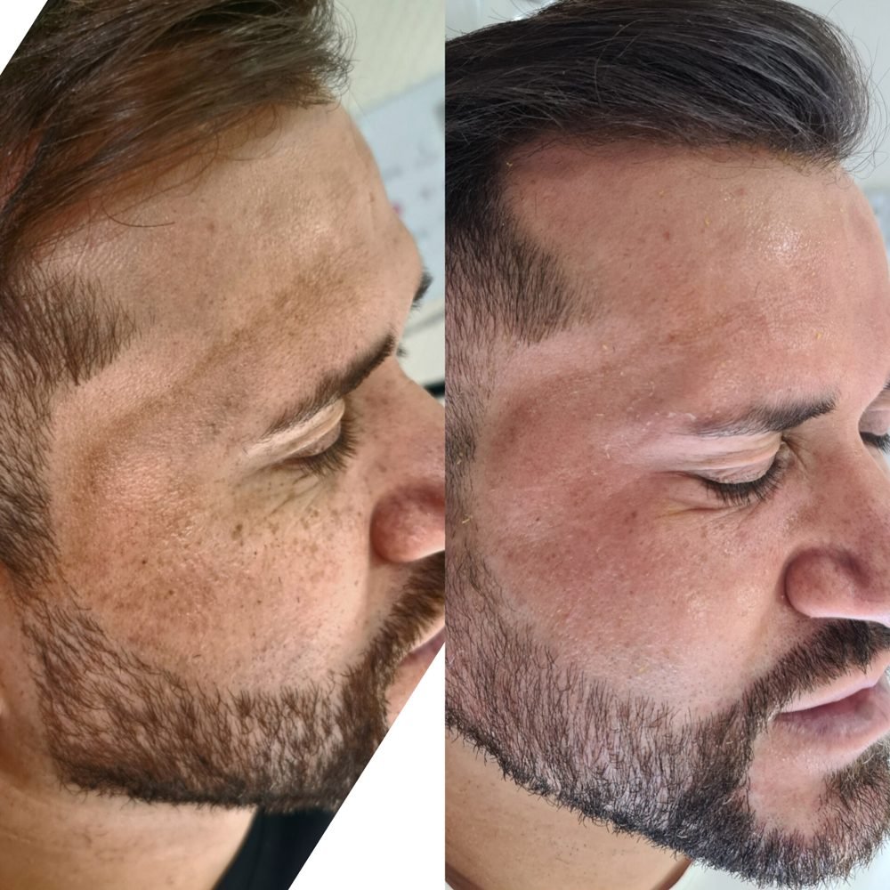 Antes e depois de caso de melasma