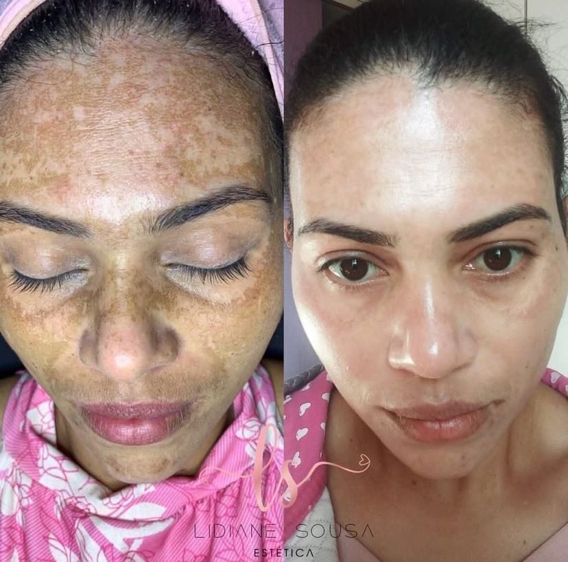 Antes e depois de caso de melasma