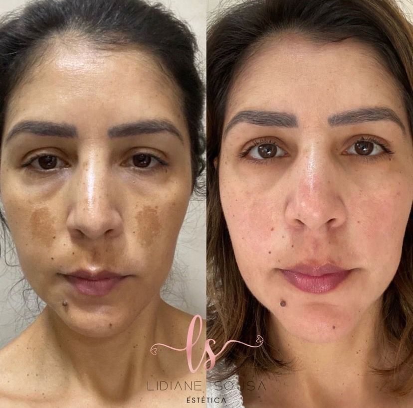 Antes e depois de caso de melasma