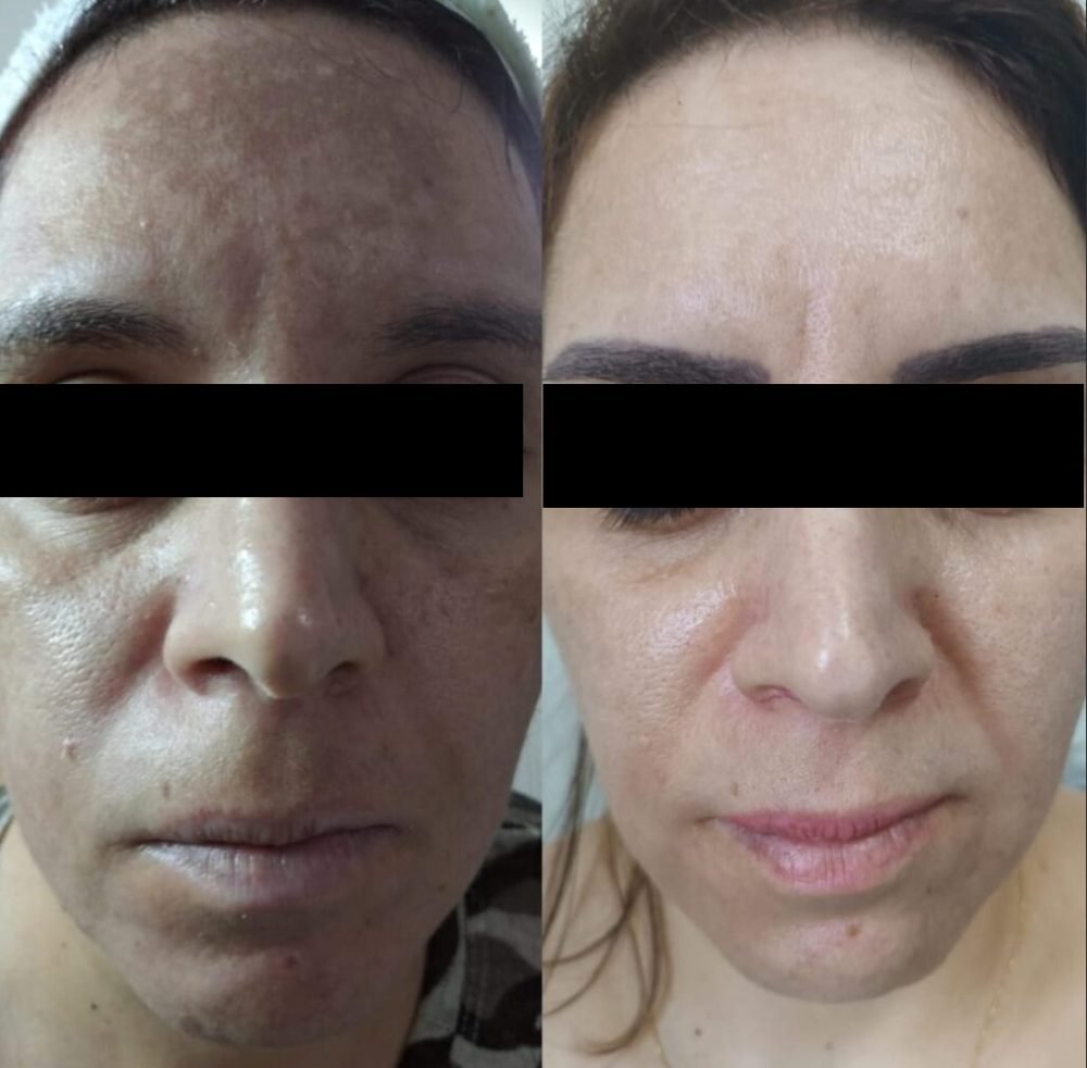 Antes e depois de caso de melasma
