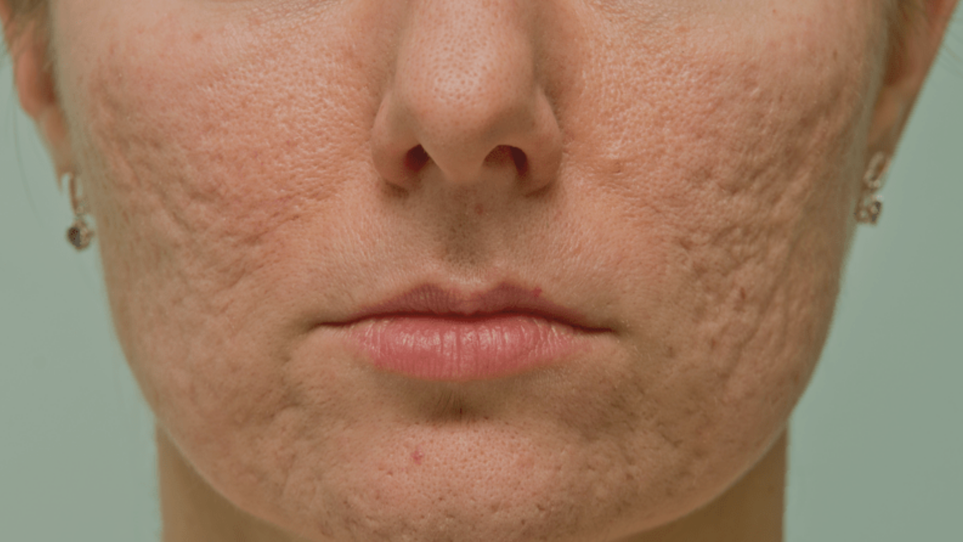 O que são Cicatrizes de Acne?