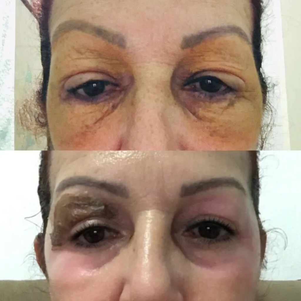 Peeling – resultado de procedimento realizado pelo Dr. Filipe Ferrara