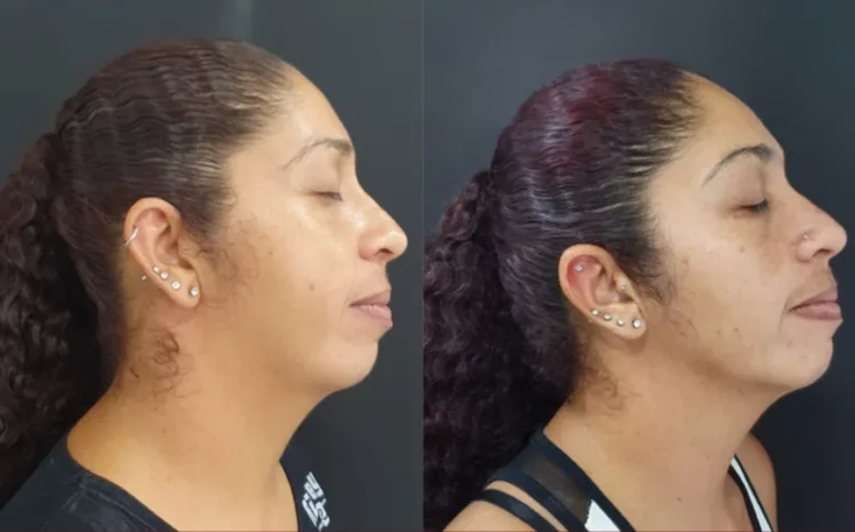 Resultado antes e depois