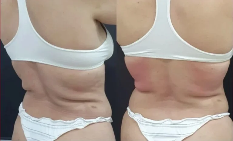 Resultado antes e depois