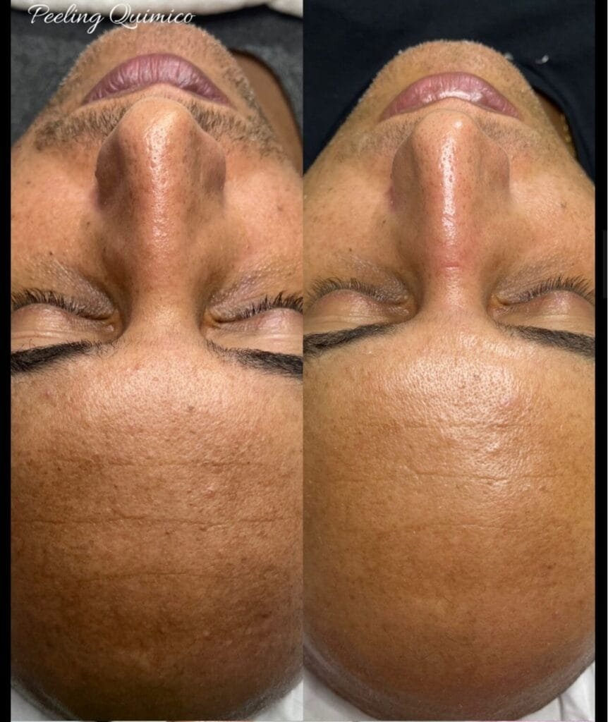 Peeling regenerativo – resultado de procedimento realizado pelo Dr. Filipe Ferrara