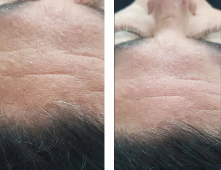 Resultado antes e depois