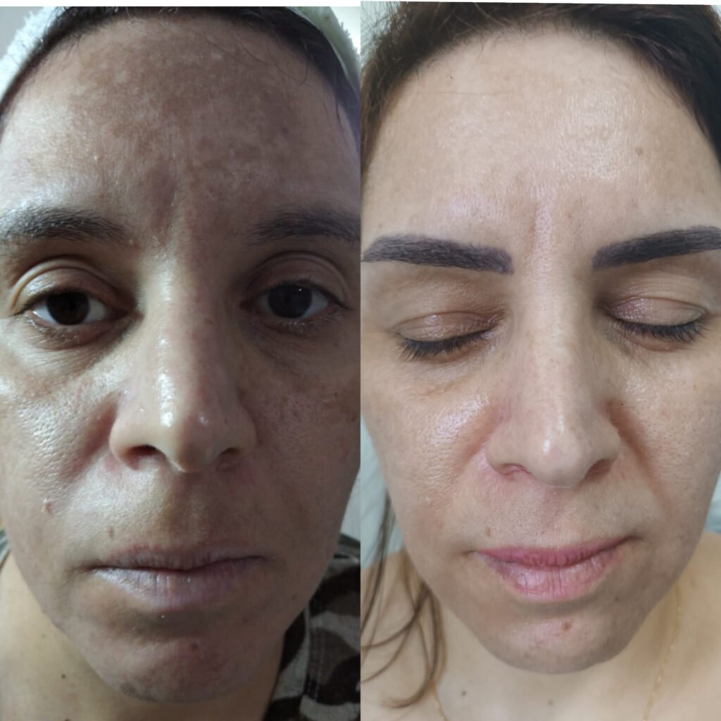 Tratamento de melasma – resultado de procedimento realizado pelo Dr. Filipe Ferrara