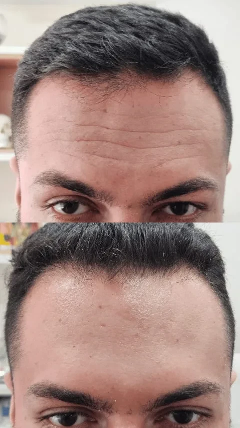 Peeling regenerativo – antes e depois – resultado de procedimento realizado pelo Dr. Filipe Ferrara