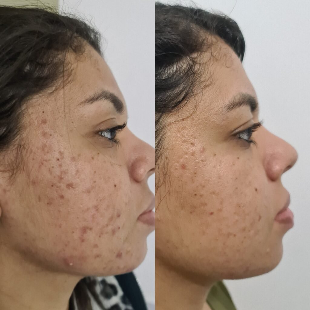 Tratamento de acne – resultado de procedimento realizado pelo Dr. Filipe Ferrara