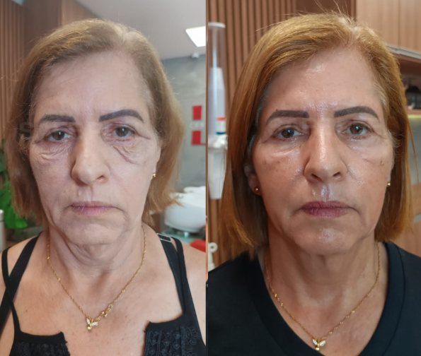 Rejuvenescimento facial – resultado de procedimento realizado pelo Dr. Filipe Ferrara