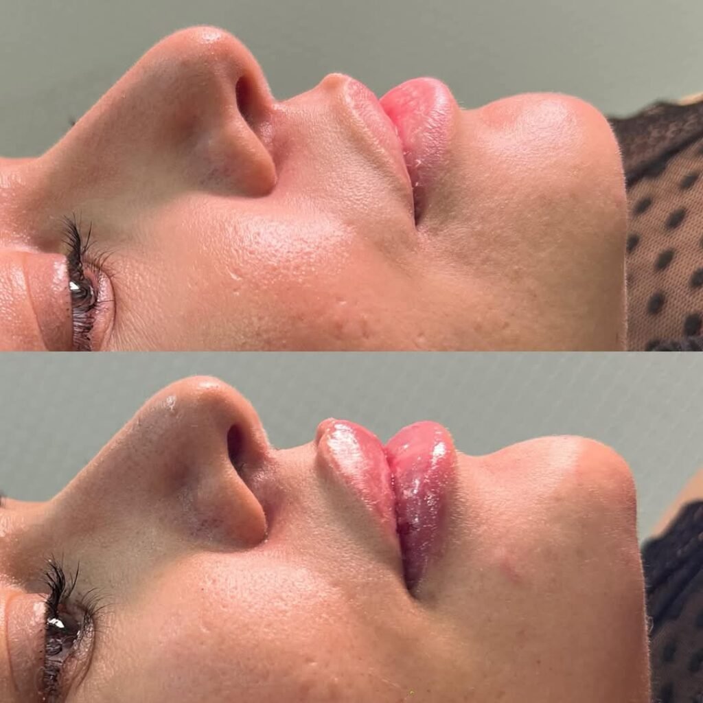 Preenchimento labial – perfil – resultado de procedimento realizado pelo Dr. Filipe Ferrara