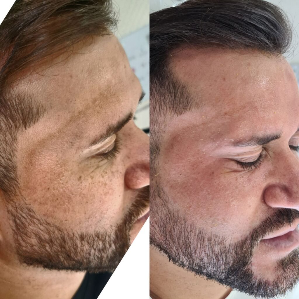 Tratamento de melasma – resultado de procedimento realizado pelo Dr. Filipe Ferrara