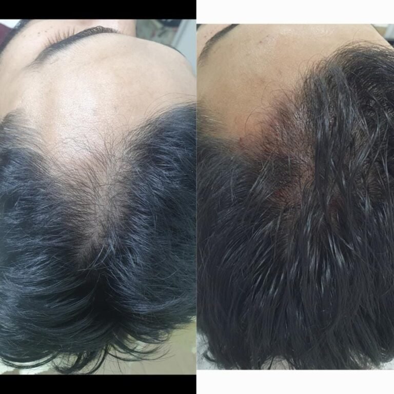 Terapia capilar – resultado de procedimento realizado pelo Dr. Filipe Ferrara