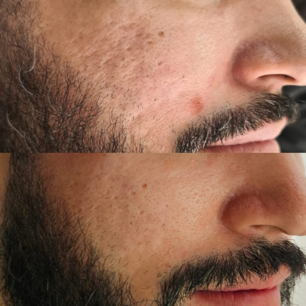 Cicatrizes de acne – resultado de procedimento realizado pelo Dr. Filipe Ferrara