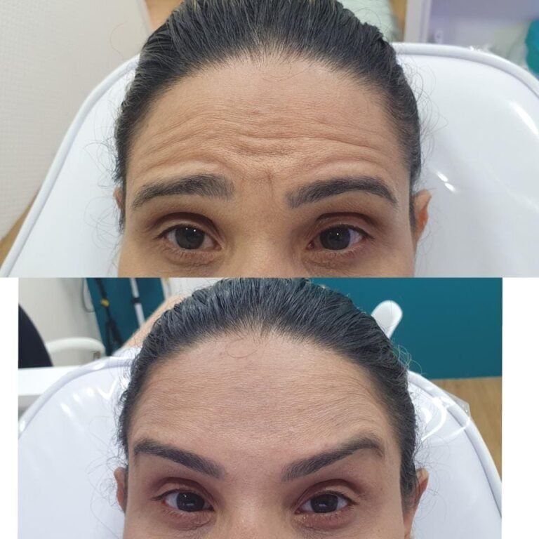 Toxina botulínica – resultado de procedimento realizado pelo Dr. Filipe Ferrara