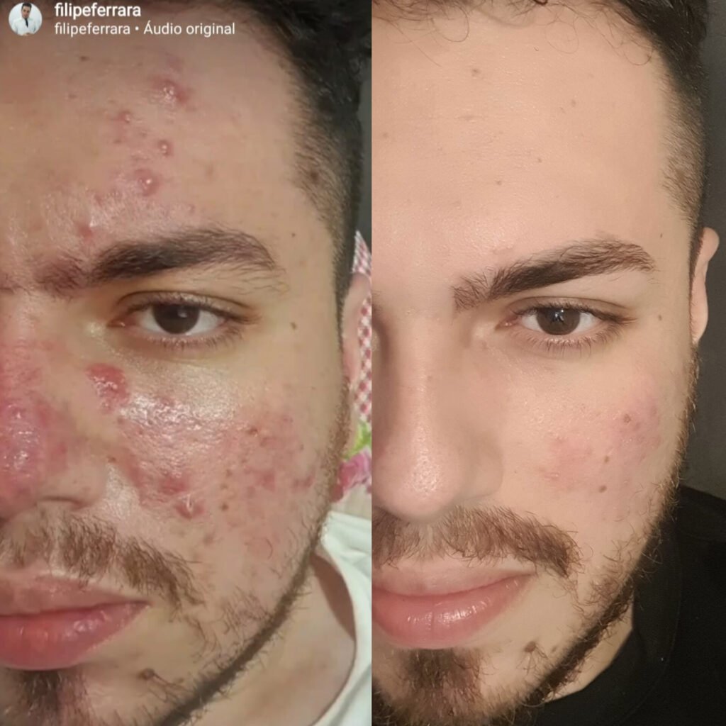 Tratamento de acne – resultado de procedimento realizado pelo Dr. Filipe Ferrara