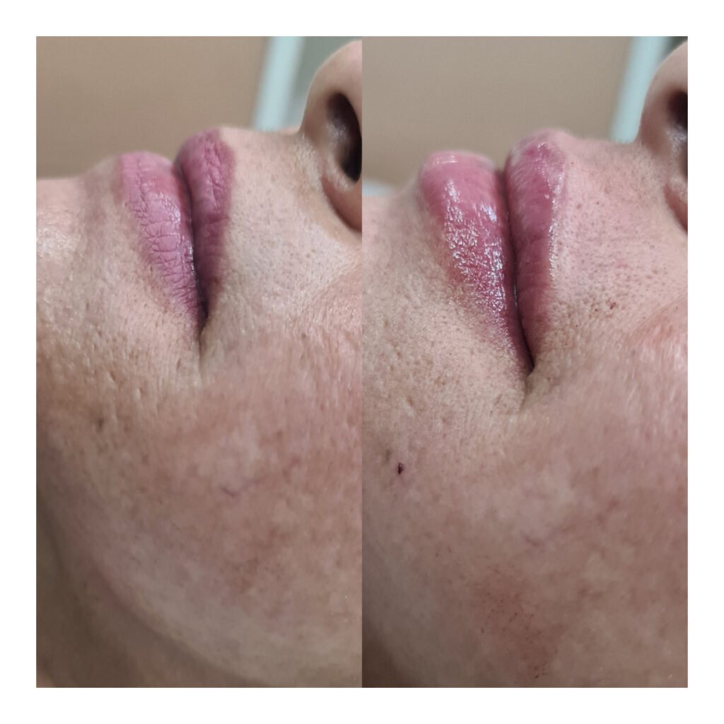 Preenchimento labial – resultado de procedimento realizado pelo Dr. Filipe Ferrara