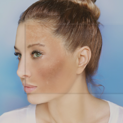 Melasma profundo: como identificar e tratar os casos mais difíceis