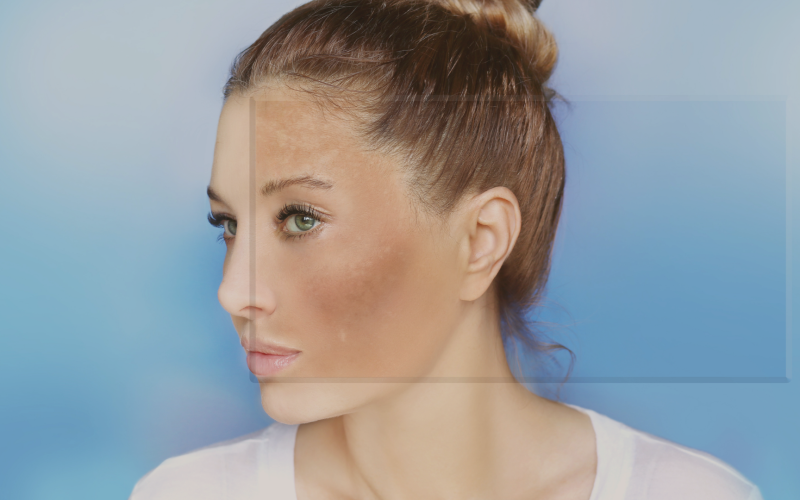 Melasma profundo: como identificar e tratar os casos mais difíceis