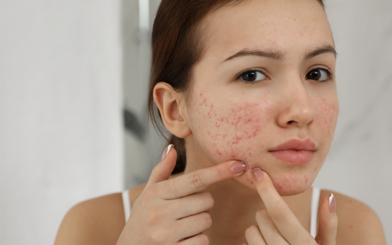 SOP e Acne: Entenda a Relação