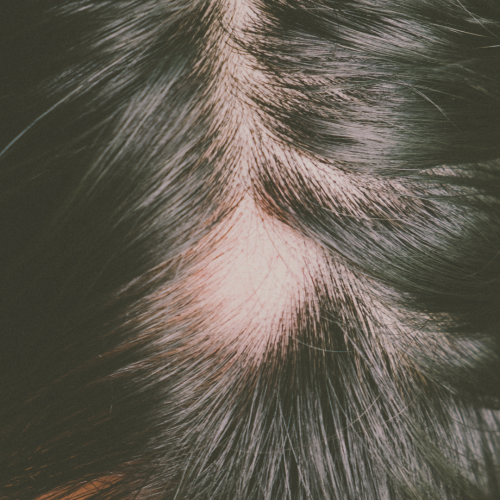 Alopecia Areata: O Que é ?