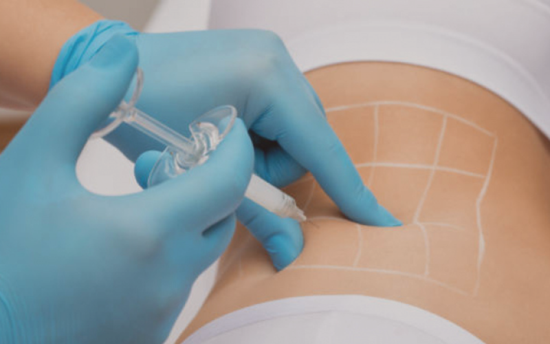 O que é Intradermoterapia para Gordura Localizada?