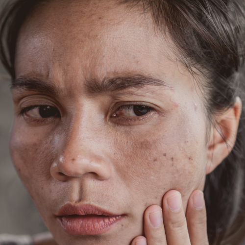 Melasma no Rosto: O Que É,